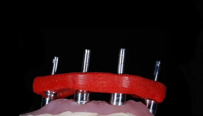 Protesi su impianti realizzata dal laboratorio