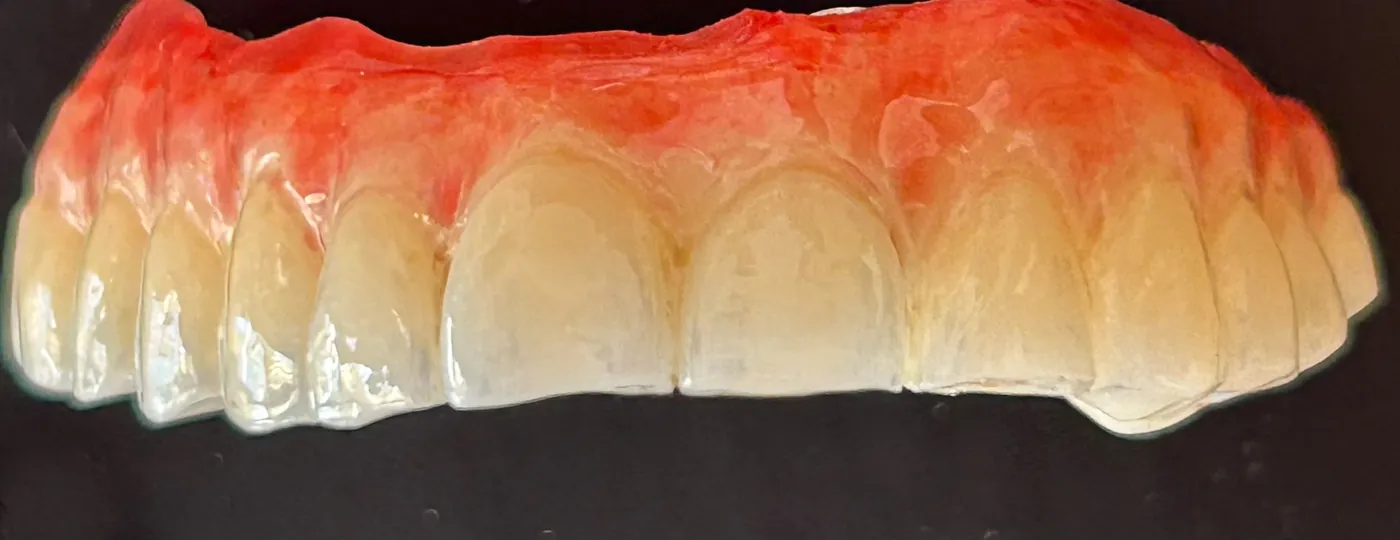 Split bar: protesi su impianti realizzata in CAD/CAM