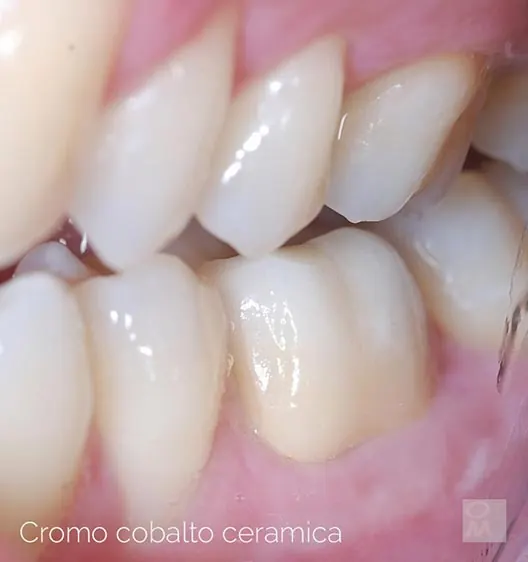 Ponte in cromo cobalto ceramica sui denti posteriori
