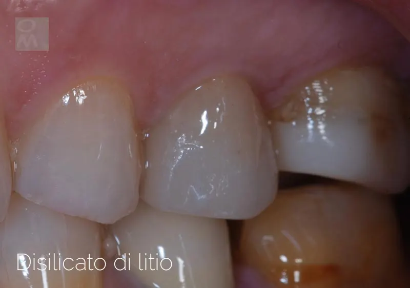 Corona in disilicato di litio su premolare