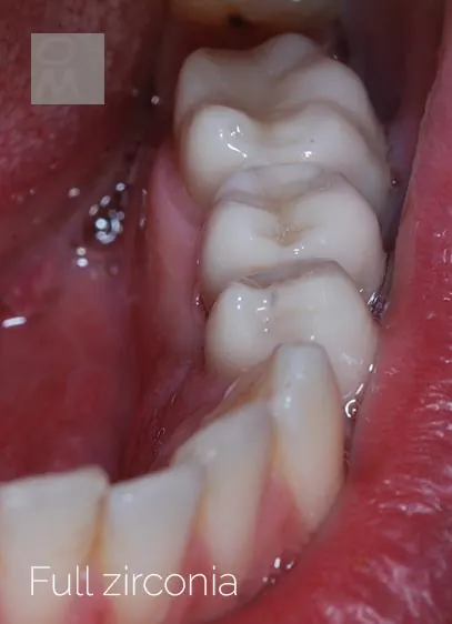 Ponte in full zirconia nei settori posteriori
