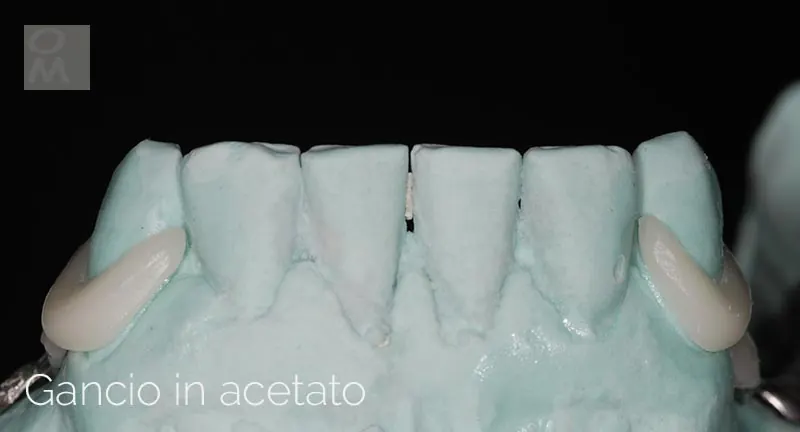 Gancio in acetato estetico su modello in gesso