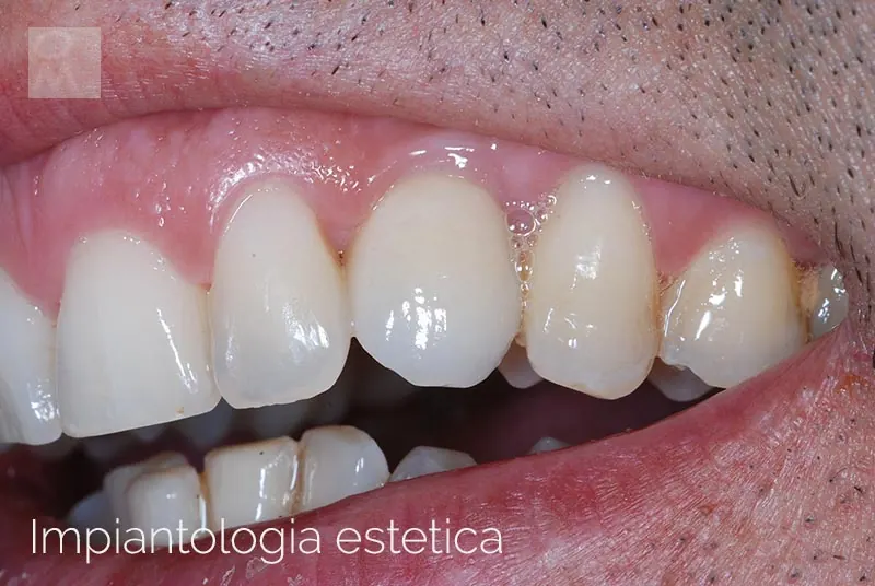 Implantologia estetica: protesi su impianti nei settori laterali