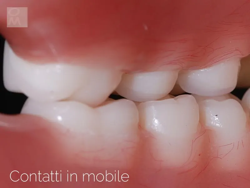 Contatti occlusali su protesi mobile