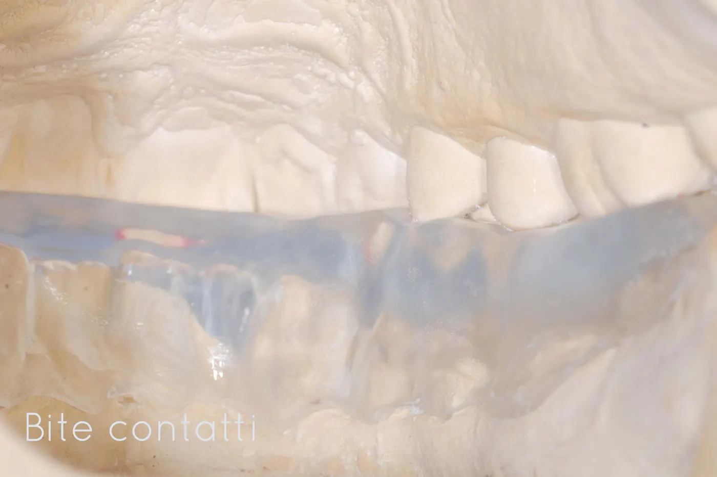 Bite con registrazione dei contatti occlusali