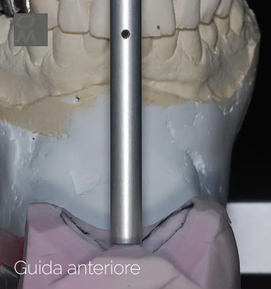 Guida anteriore regolata in articolatore